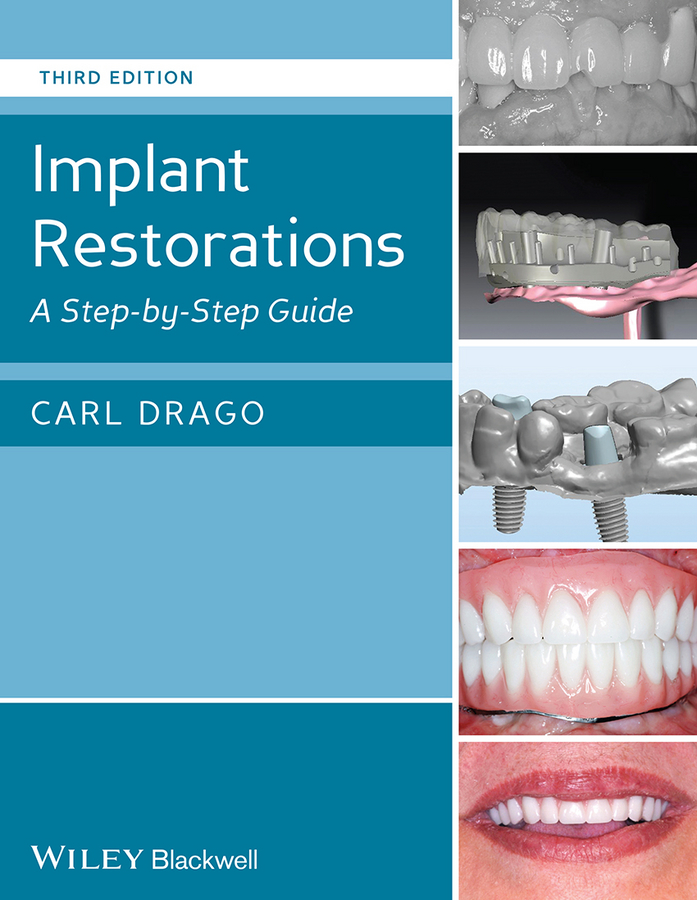 Implant Restorations: A Step–by–Step Guide