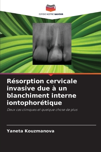 Résorption cervicale invasive due à un blanchiment interne iontophorétique