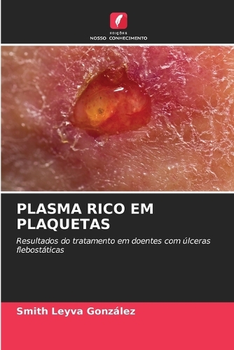 Plasma Rico Em Plaquetas